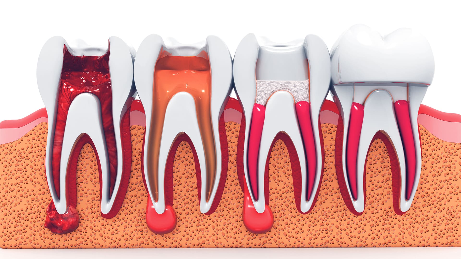 endodoncia en Miraflores tratamiento de conducto OdontoDoc